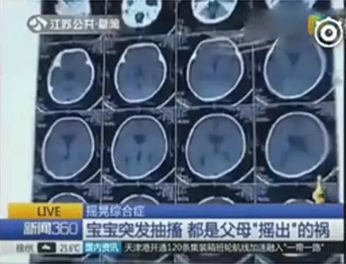 多名婴儿脑出血，家长一个不经意的作为竟然对宝宝中伤这么大1.webp.jpg